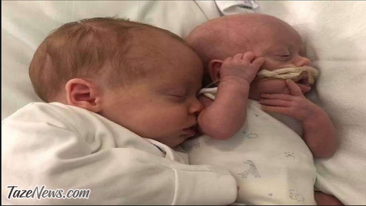 نجات دوقلو‌های همسان