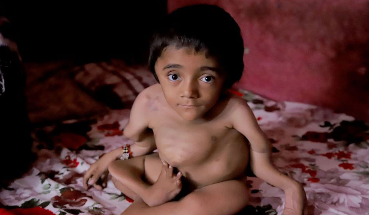 پوکی استخوان شدید پسر ۱۲ ساله هندی