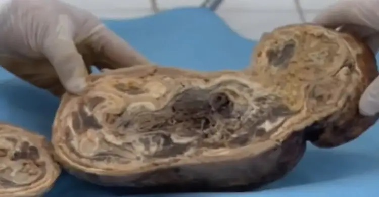 سونوگرافی نوزاد سنگی