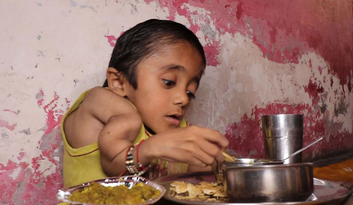 پوکی استخوان شدید پسر ۱۲ ساله هندی