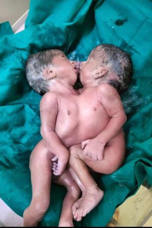 دوقلوهای هندی به هم چسبیده تولد