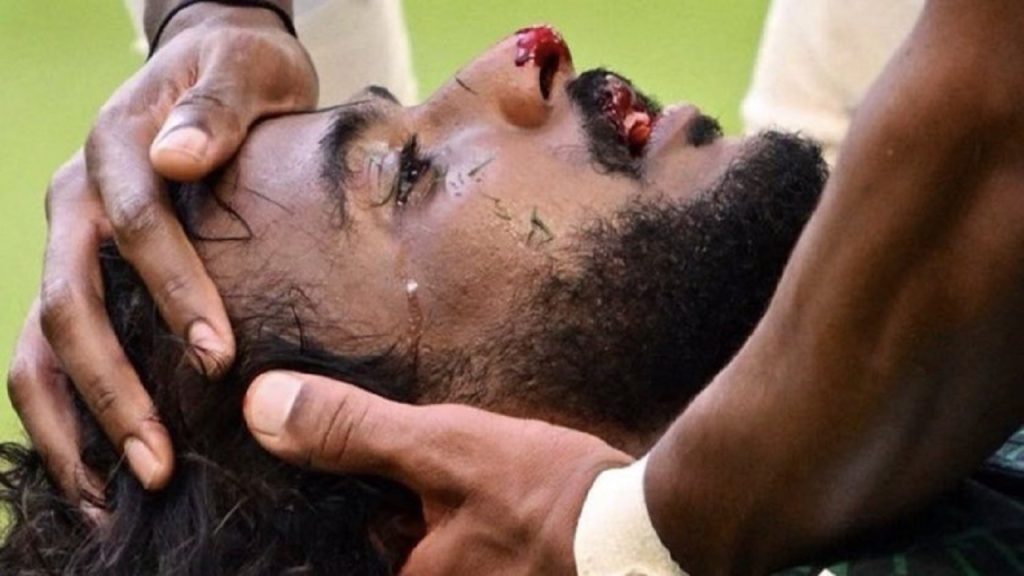 جمجمه بازیکن عربستان خرد شد